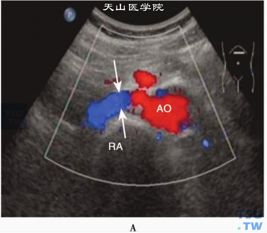 正常肾动脉CDFI：右肾动脉（RA）从腹主动脉（AO）分出后近段层流血流信号（箭头）