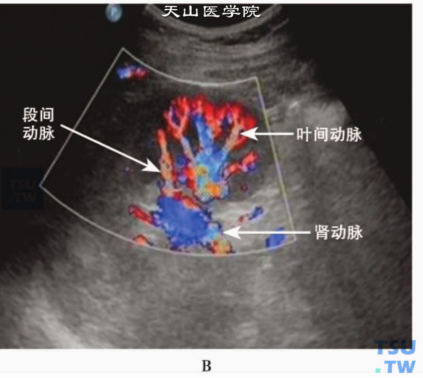 正常肾动脉CDFI：各级肾动、静脉呈“树枝状”分布的彩色血流信号图