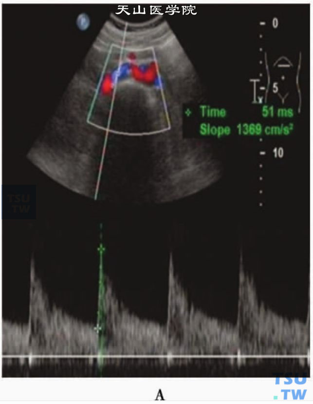 正常肾动脉PW：肾外近段肾动脉PW显示AC为1369cm/s2，AT为005秒