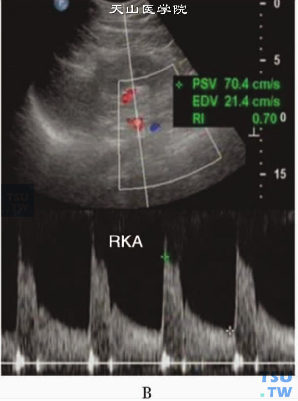 正常肾动脉PW：肾门处肾动脉PW显示Vs为704cm/s，RI为070