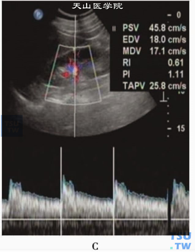 正常肾动脉PW：段间肾动脉PW显示Vs为458cm/s，RI为061