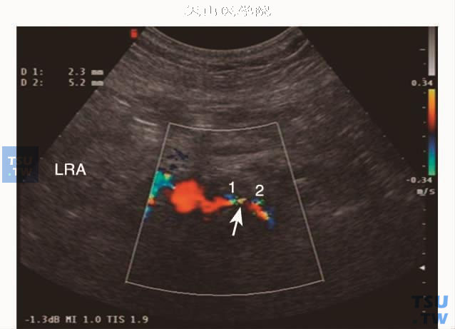  左肾动脉狭窄CDFI显示狭窄出口“五彩镶嵌”血流信号（箭头）