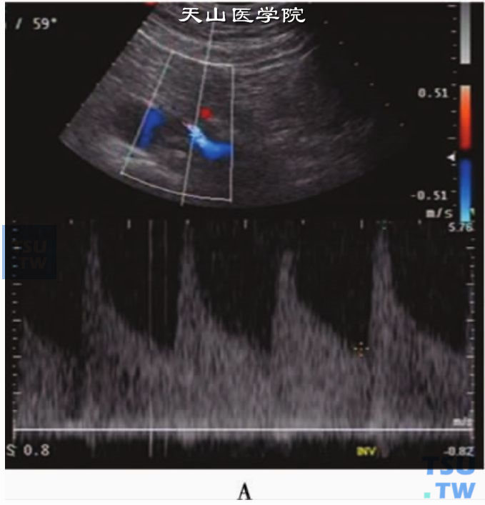 肾动脉狭窄PW：肾外近段主肾动脉狭窄PW显示Vs为573cm/s，Vd为273cm/s