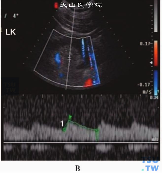 肾动脉狭窄PW：段间肾动脉PW显示AC为105. 4cm/s2，AT为0. 13秒