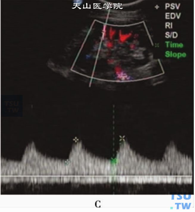 肾动脉狭窄PW：叶间肾动脉PW显示AC为98. 1cm/s2，AT为0. 18秒