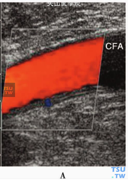正常下肢动脉CDFI显示层流血流信号：股总动脉（CFA）