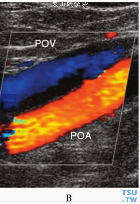 正常下肢动脉CDFI显示层流血流信号：腘动、静脉（POA、POV）