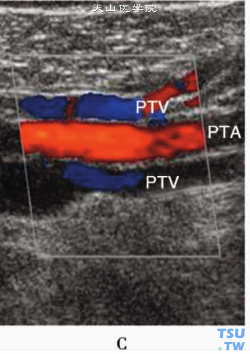 正常下肢动脉CDFI显示层流血流信号：胫后动、静脉（PTA、PTV）