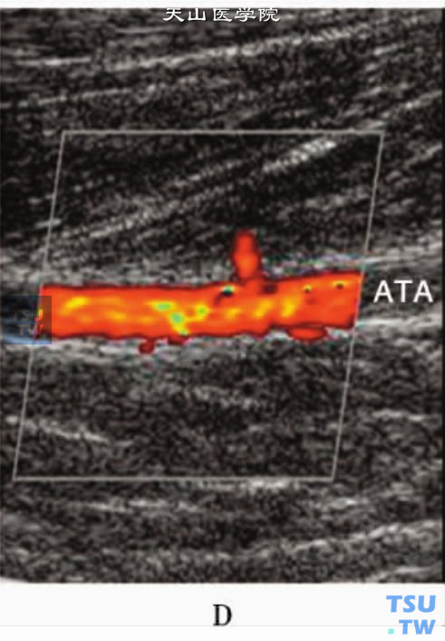 正常下肢动脉CDFI显示层流血流信号：胫前动脉（ATA）