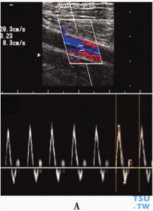 正常人下肢动脉PW显示“三相高阻”血流频谱：股浅动脉PW