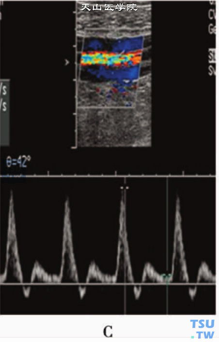 正常人下肢动脉PW显示“三相高阻”血流频谱：胫后动脉PW
