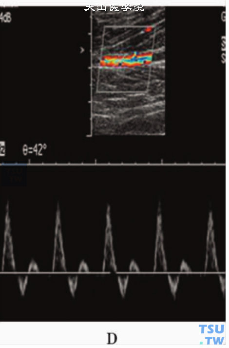 正常人下肢动脉PW显示“三相高阻”血流频谱：胫前动脉PW