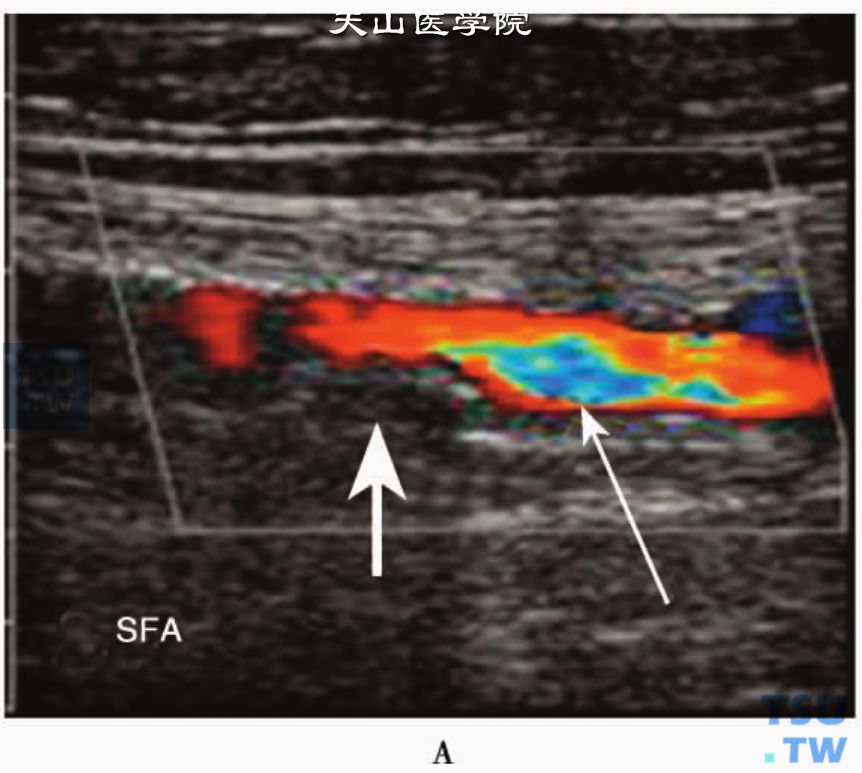 下肢动脉粥样硬化CDFI：股浅动脉（SFA）等回声斑块（短粗箭头）致狭窄处血流束变细，狭窄出口处呈“五彩镶嵌”血流信号（长细箭头）