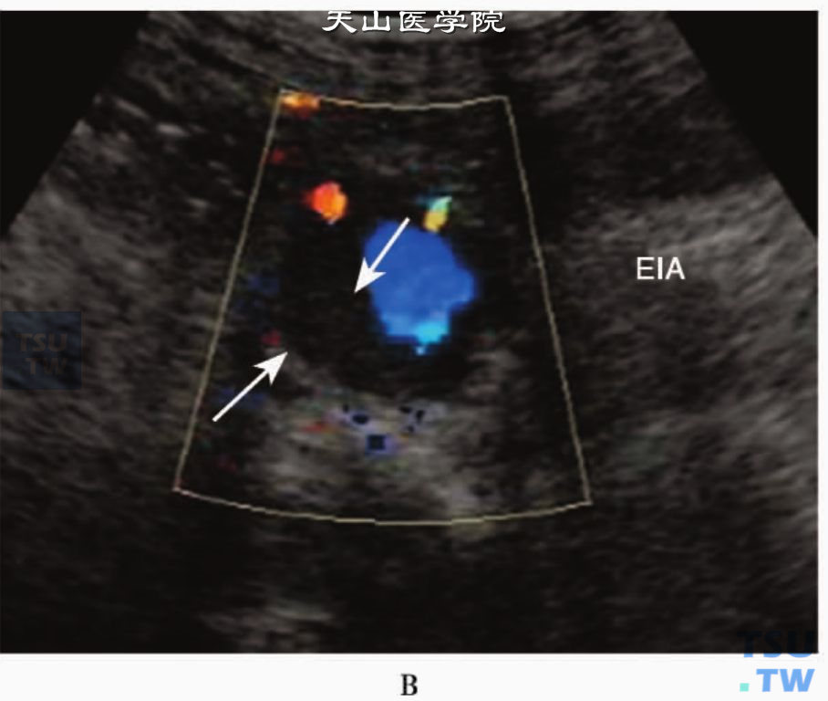 下肢动脉粥样硬化CDFI：髂外动脉（EIA）内侧壁低回声斑块（箭头）致血流信号（蓝色）偏心