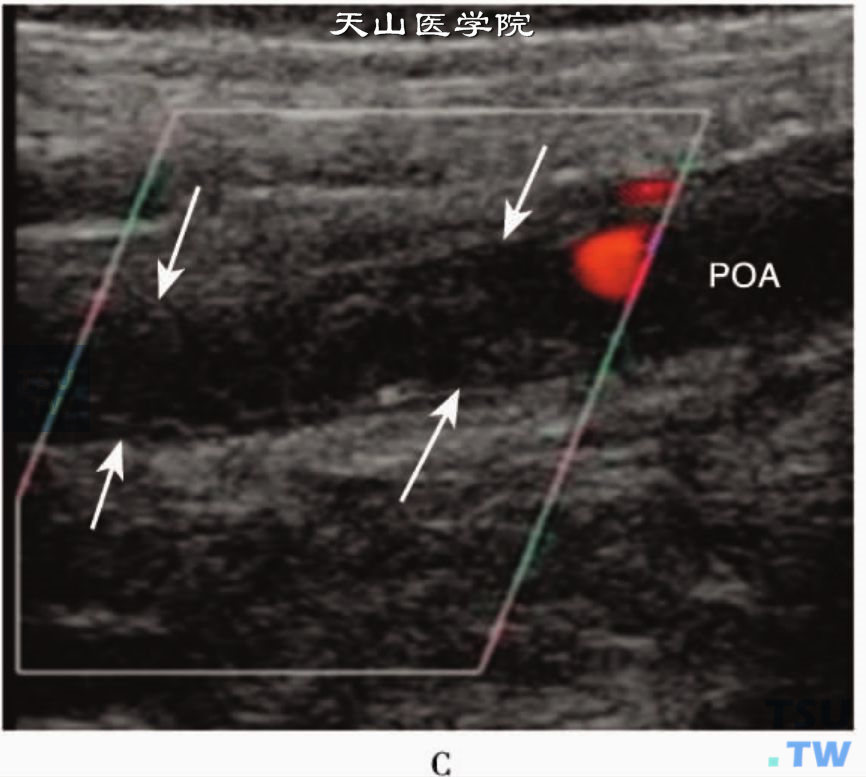 下肢动脉粥样硬化CDFI：腘动脉（POA）上段闭塞致血管腔内无明显血流信号显示（箭头）