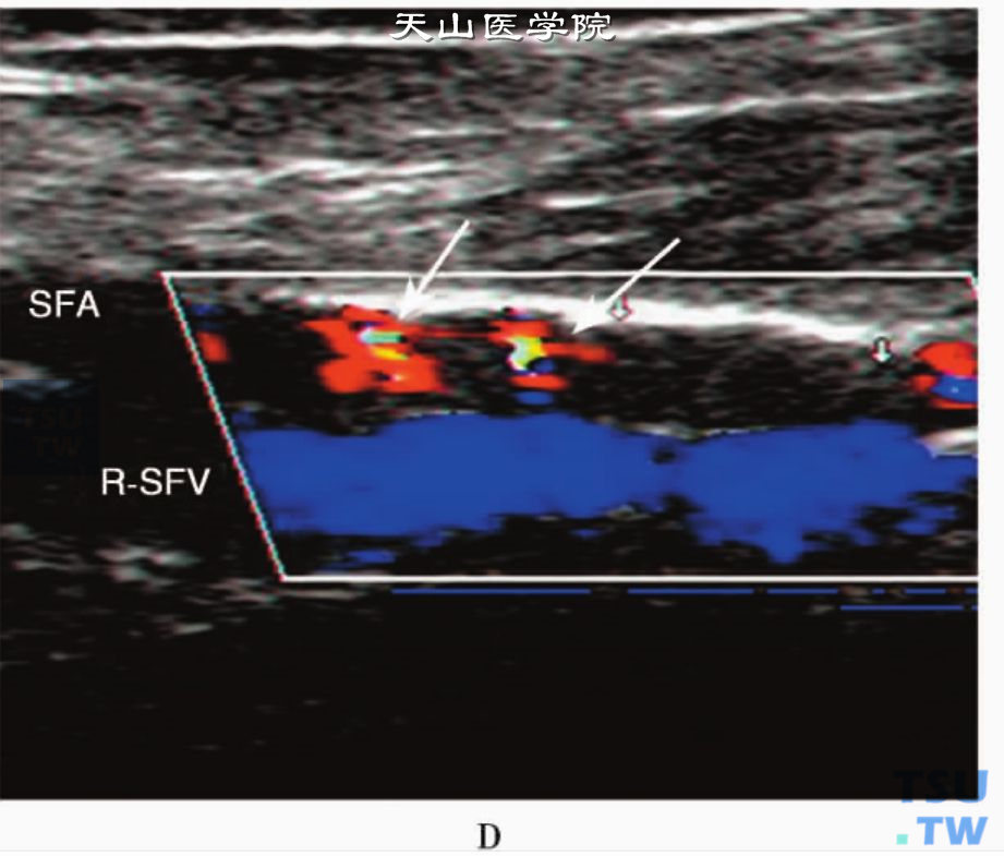 下肢动脉粥样硬化CDFI：股浅动脉（SFA）中段血管闭塞后部分再通，血管内显示不规则、断续血流信号（箭头），其后方右股浅静脉（R-SFV）血流信号显示良好