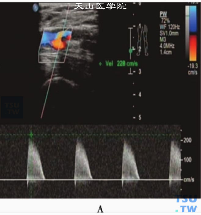 下肢动脉粥样硬化性狭窄或闭塞PW：股动脉狭窄开口处显示“单相”高速（Vs为228cm/s）湍流血流频谱，频窗小，频带宽