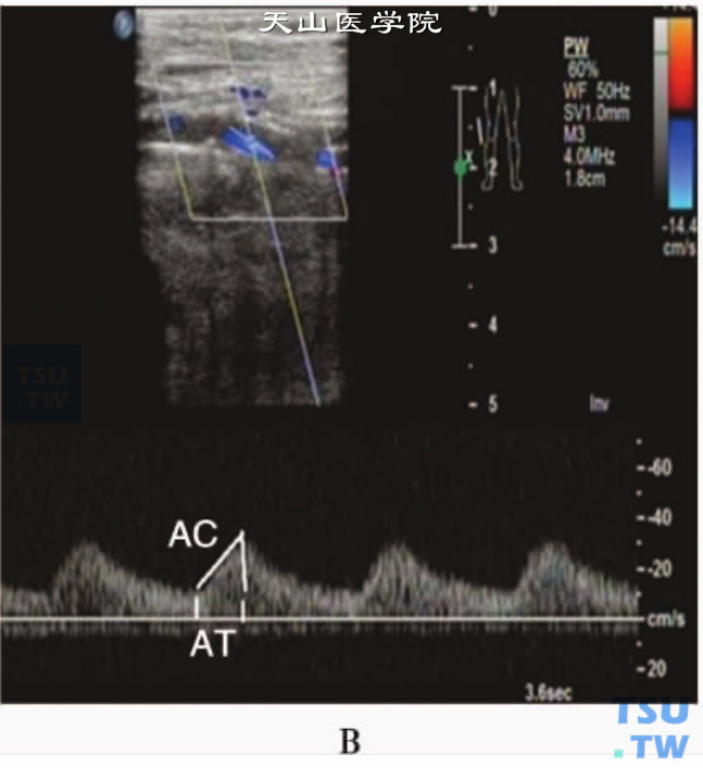 下肢动脉粥样硬化性狭窄或闭塞PW：股动脉狭窄远端显示“单相低速”血流频谱，频窗小，频带宽，AC减小，AT延长