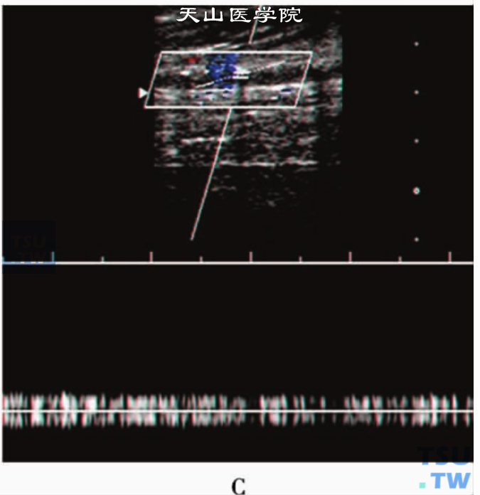 下肢动脉粥样硬化性狭窄或闭塞PW：胫前动脉近段闭塞，其远端显示“静脉样”血流频谱