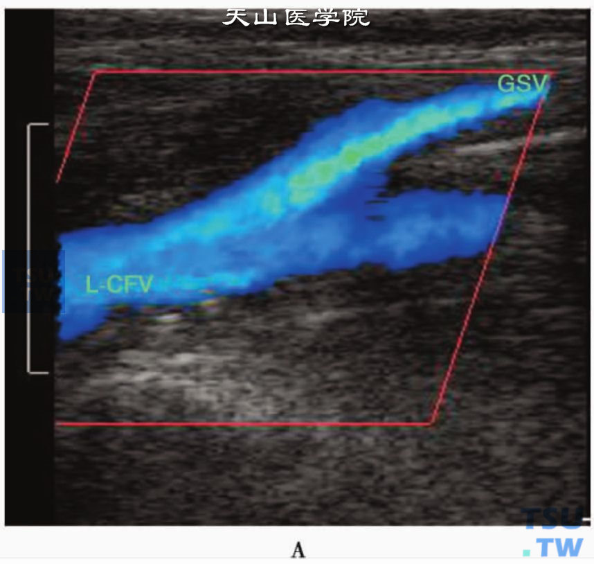 彩正常下肢静脉CDFI显示层流血流信号：左股总静脉（L-CFV）和大隐静脉（GSV）