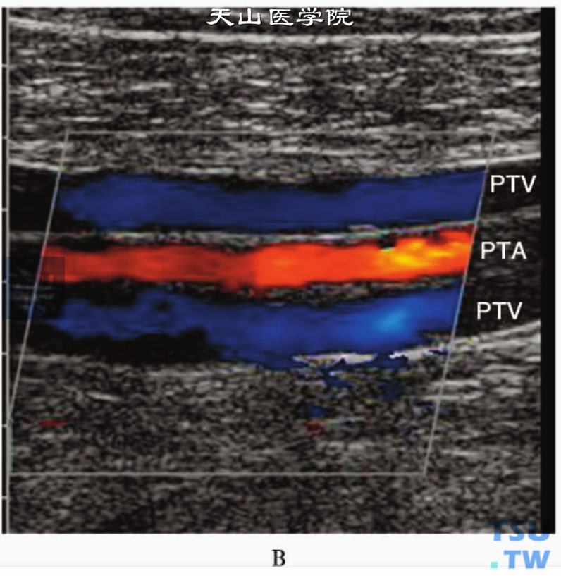 彩正常下肢静脉CDFI显示层流血流信号：胫后静脉（PTV）和胫后动脉（PTA）