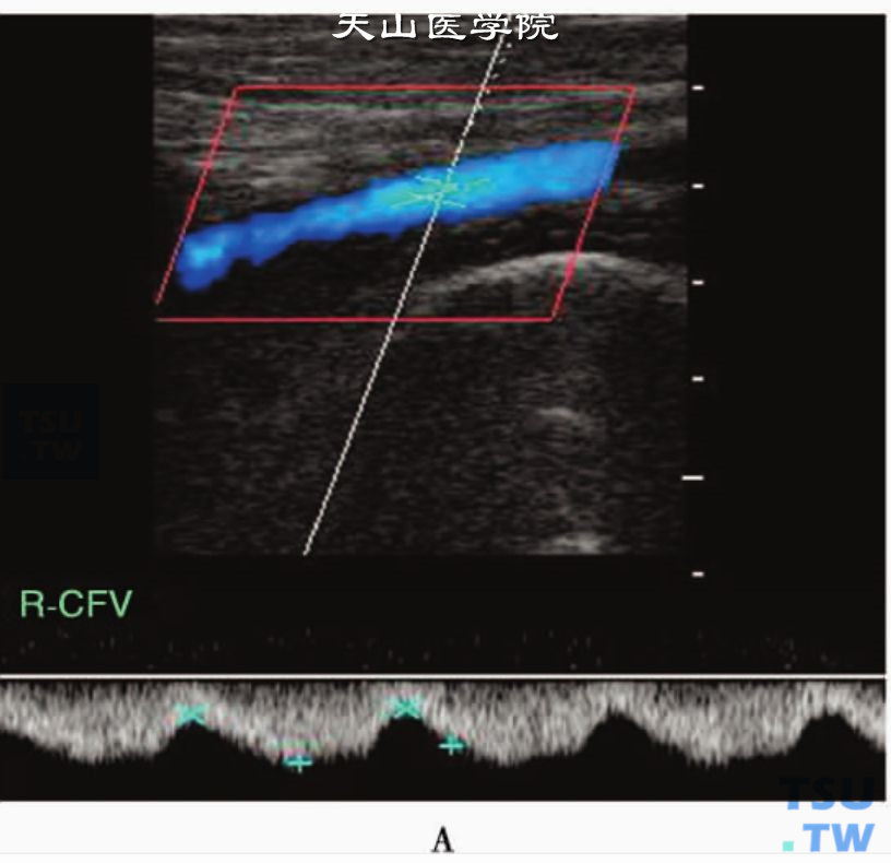 正常下肢静脉PW：右股总静脉（R-CFV）随呼吸而变化的周期性血流频谱