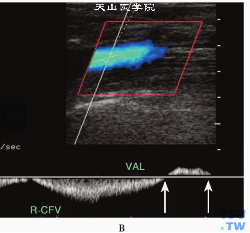 正常下肢静脉PW：右股总静脉（R-CFV）Valsalva试验时，显示短暂返流血流频谱（箭头）