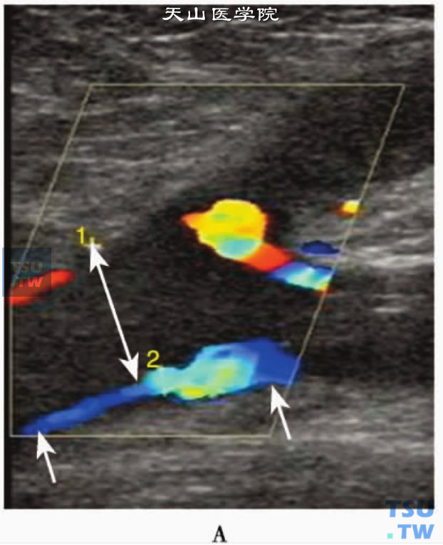 下肢静脉急性血栓CDFI：股总静脉急性血栓部分阻塞（双向箭头），显示彩色血流束变细（单向箭头）