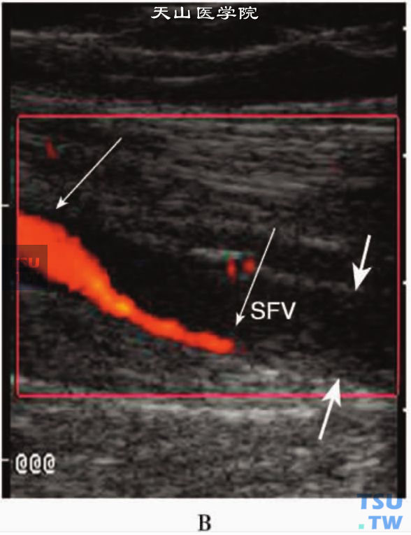 下肢静脉急性血栓CDFI：股浅静脉急性血栓部分阻塞伴彩色血流束变细（长细箭头）和完全阻塞（短粗箭头）伴无明显血流信号显示