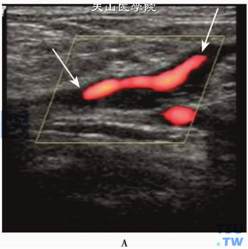    股静脉慢性血栓部分再通：彩色多普勒超声显示股静脉内变细、不规则的血流信号（箭头）