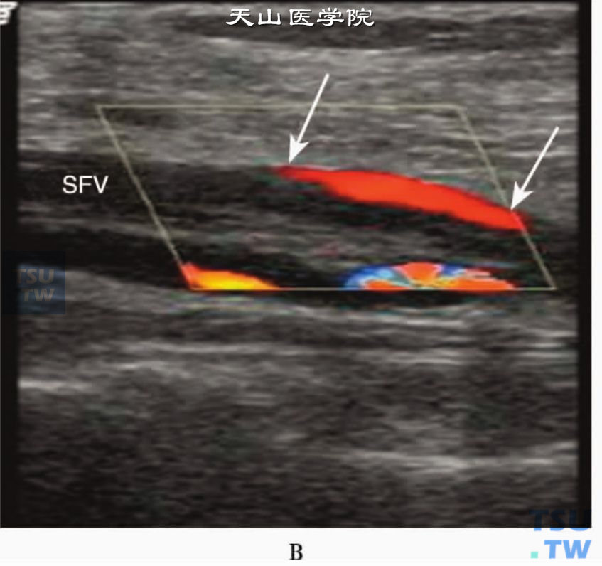  股静脉慢性血栓部分再通：SFV彩色多普勒超声显示股静脉内变细、不规则的血流信号（箭头）