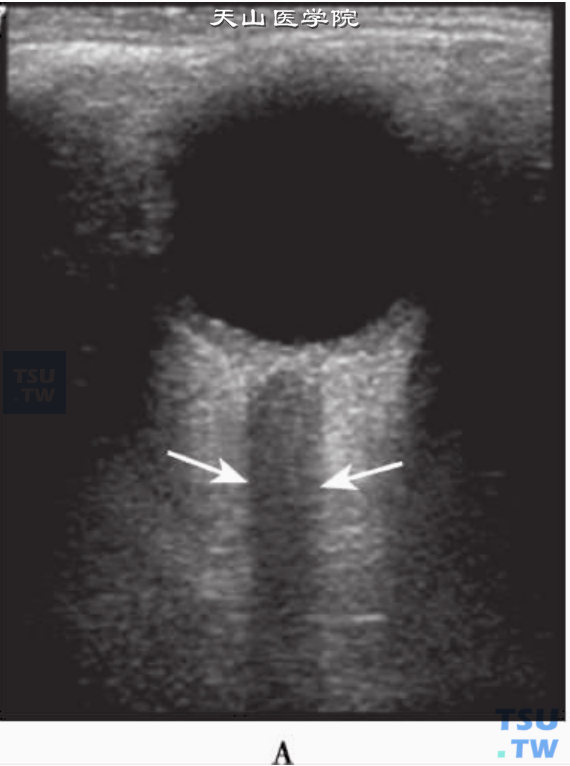 正常眼底动脉声像图：眼底二维超声显示球后视神经暗区（箭头）