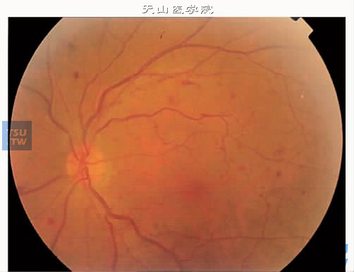  非增生性糖尿病性视网膜病变Ⅰ期，视网膜静脉充盈，散在点状出血和微血管瘤