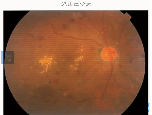 非增生性糖尿病视网膜病变散在视网膜出血，后极部有黄白色硬性渗出。硬性渗出范围1DD以上，与黄斑中心凹的距离在500μm以内，为临床显著性黄斑水肿