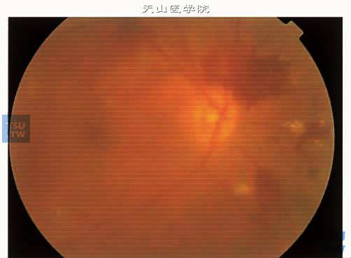 增生性糖尿病视网膜病变Ⅳ期玻璃体积血，眼底朦胧，可见视网膜出血及硬性渗出