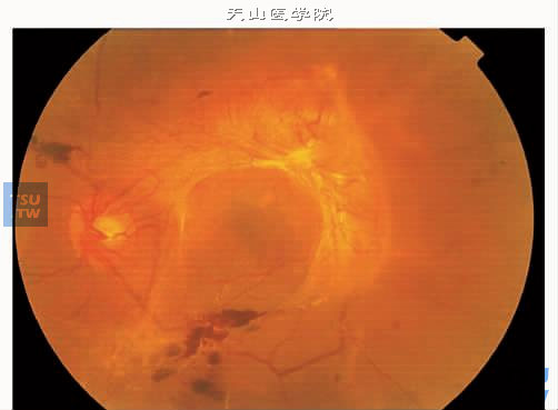 增生性糖尿病视网膜病变Ⅴ期图中大片纤维增殖膜，片状视网膜出血