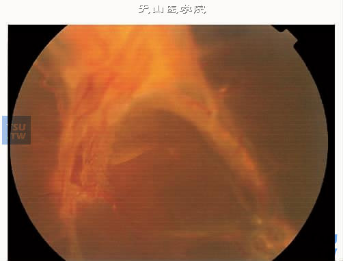 增生性糖尿病视网膜病变Ⅵ期图中显示视乳头前机化牵拉性视网膜脱离