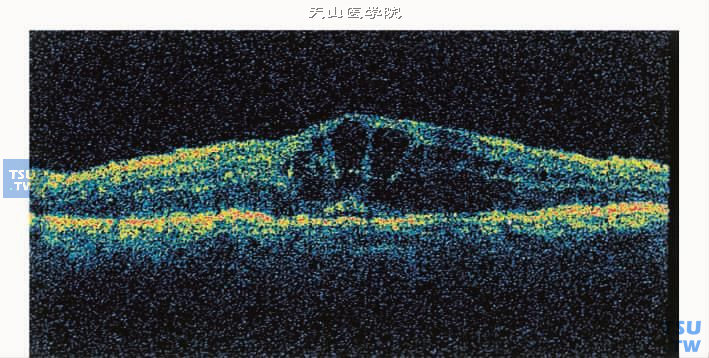  光学相干断层扫描（OCT）显示糖尿病性黄斑水肿，神经上皮层间多个囊腔，为囊样黄斑水肿