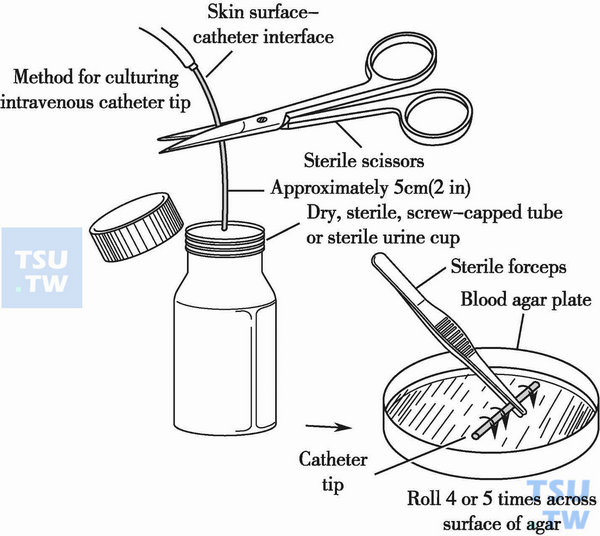  血管内导管尖端培养标本的采集和Maki半定量培养示意图