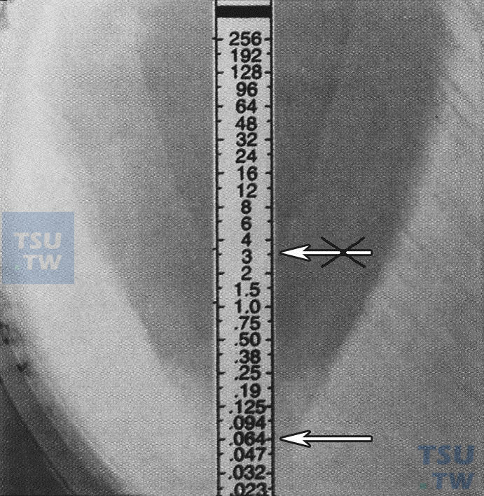 如何正确阅读溶血链球菌的E-test结果？