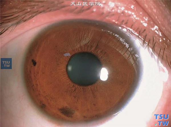 正常角膜，角膜的正常屈光状态（+43～+44D），对保持眼的正视是极为重要的，透过透明的角膜，可以观察眼内的组织，可见虹膜色素痣，晶状体透明