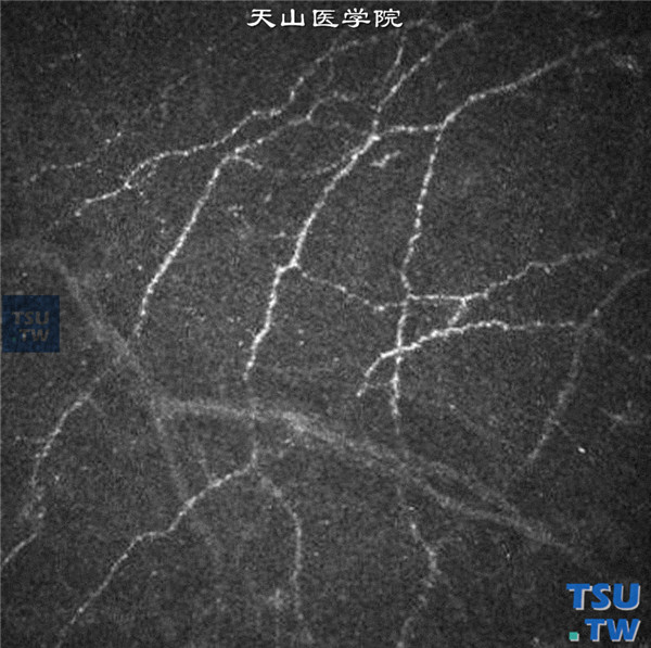 临床共聚焦显微镜显示角膜上皮下和上皮内神经，清晰，呈树枝状分布，正常神经密度可以通过计算机软件测量，病变时神经密度减少 ×800