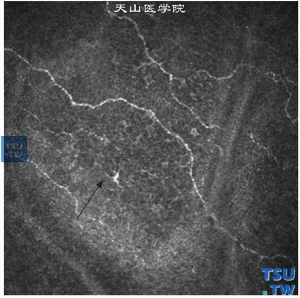 临床共聚焦显微镜检查角膜周边部，偶见Langhans细胞，神经的外形呈树枝状分布，神经分支的密度也是正常的 ×800