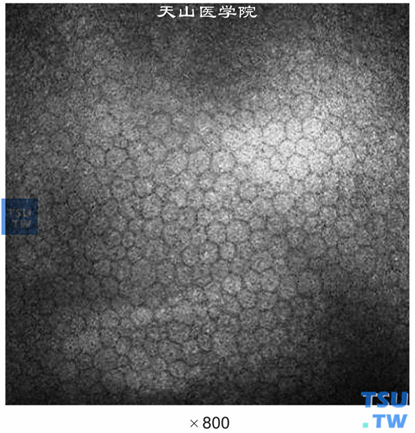 临床共聚焦显微镜显示正常人角膜内皮细胞，呈正六边形，大小均匀，较内皮显微镜图像清晰，富有立体感