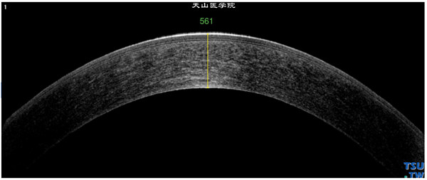 RTvue OCT 显示局部角膜组织结构和角膜厚度，图像上可以分辨角膜上皮层、基质层和内皮层的大体图像，为观察局部病变范围提供帮助