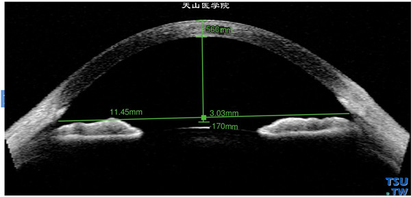 正常眼角膜光学相干断层成像