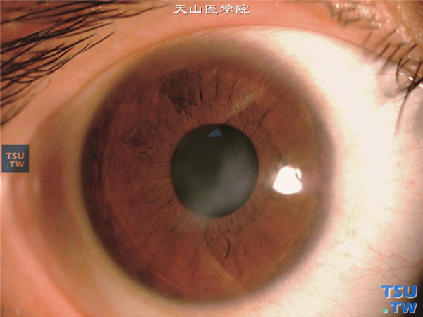眼角膜云翳，眼角膜瘢痕薄如云雾，没有清晰的边界，无炎症表现
