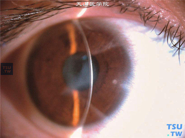 同一患者，裂隙灯显微镜检查，可见眼角膜的浅基质层混浊，眼角膜厚度基本正常
