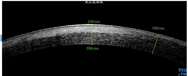 同一患者，RTvue OCT 检查，显示眼角膜瘢痕在眼角膜浅基质层，但不致密，上皮层完整，眼角膜基质没有明显水肿，厚度接近正常部位眼角膜