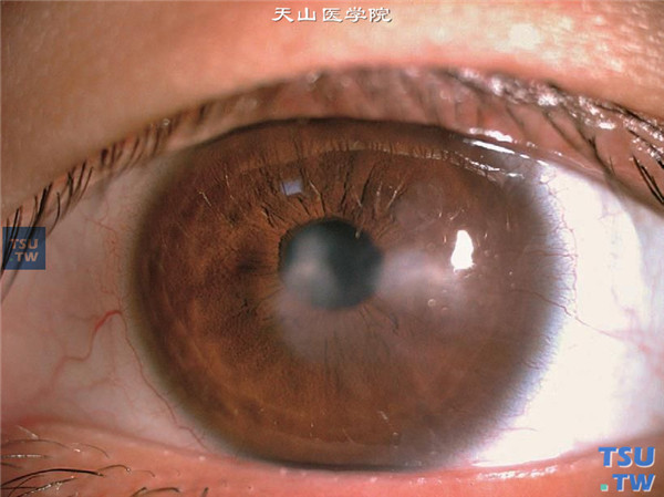 眼角膜斑翳，眼角膜瘢痕外观淡白色，边界较清楚，无明显炎症